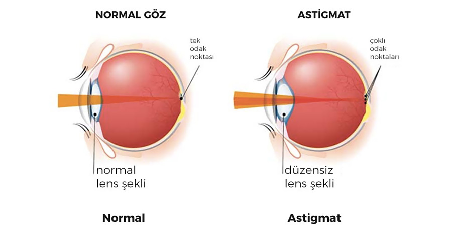 Astigmatizma
